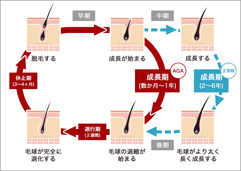 AGAの図解
